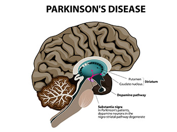Dealing with Parkinson’s in our Tuscaloosa Assisted Living Community